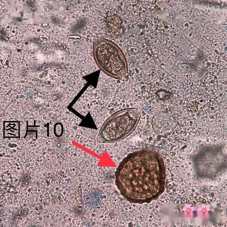 ▼「鞭虫卵(黑色箭头)」形态特征:腰鼓形(橄榄形),黄褐色,大小50～54