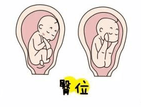 臀位宝宝出生头扁长图片