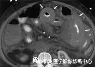 弹簧|图解21种腹部疼痛原因