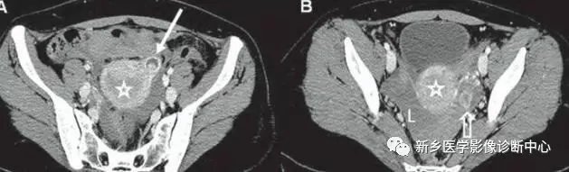 弹簧|图解21种腹部疼痛原因