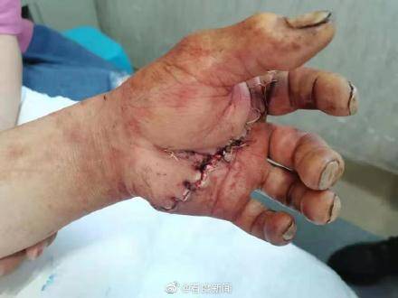 手术|四川运用疫苗冷链技术成功实施断掌再植手术