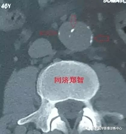 弹簧|图解21种腹部疼痛原因