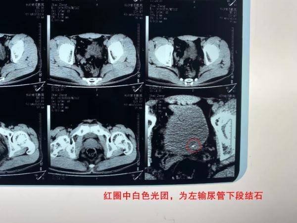 输尿管|男子每年夏天饮料代替水，反复腹痛检查结果令人意外