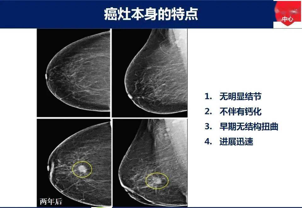 乳腺癌x線常見漏診及誤診