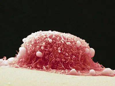 尖锐湿疣是由人乳头瘤病毒(hpv)感染所致的以肛门生殖器部位增生性