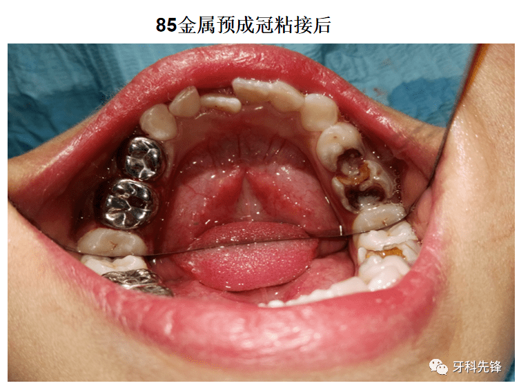 病例乳牙7585大面积龋坏根管治疗金属预成冠修复