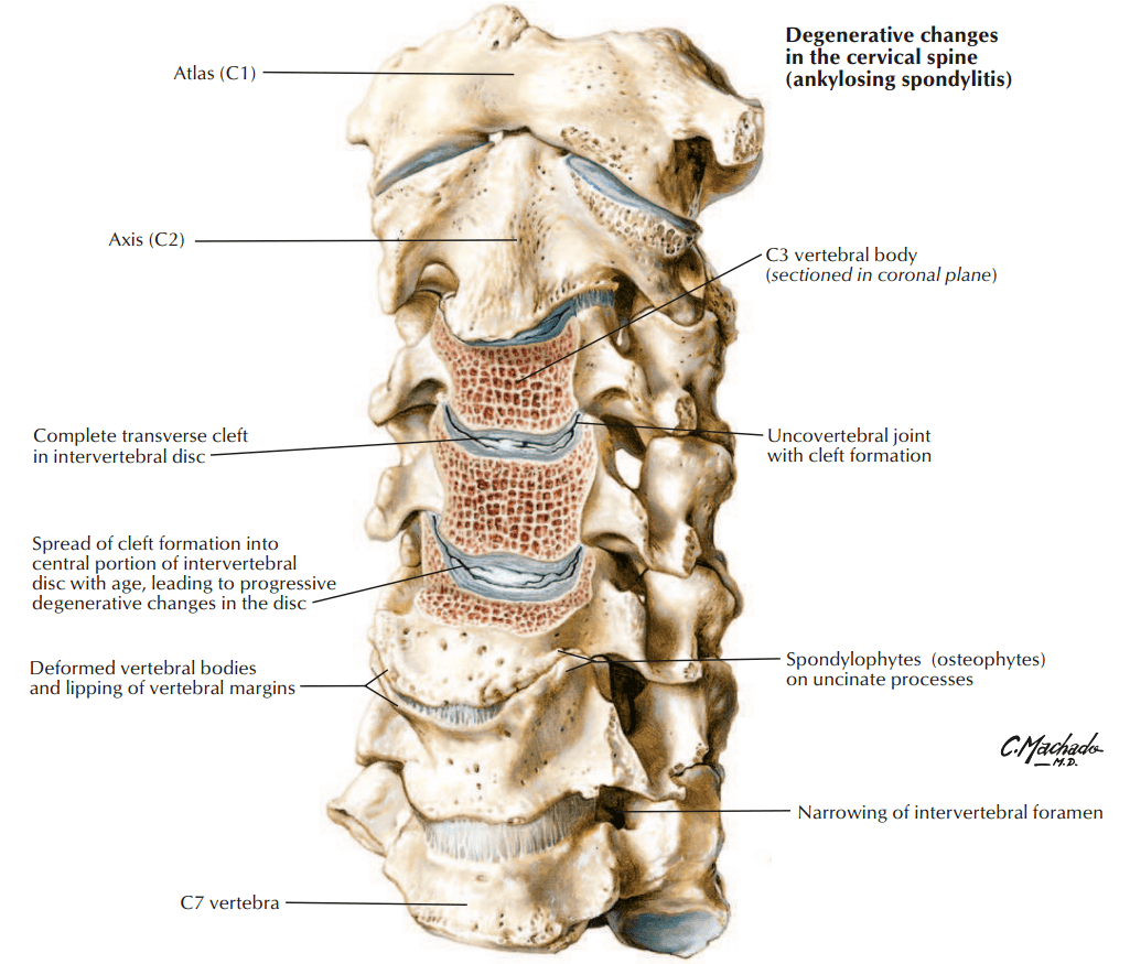 图:冠状面,在钩突(u)之间,c6椎体呈凹面向上,与c5的凸面向下形成椎间