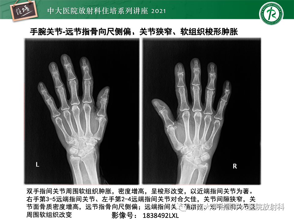 类风湿关节炎的影像学诊断