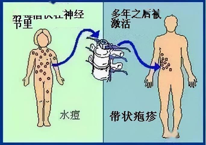 有人说得过带状疱疹的人容易得癌是真的吗