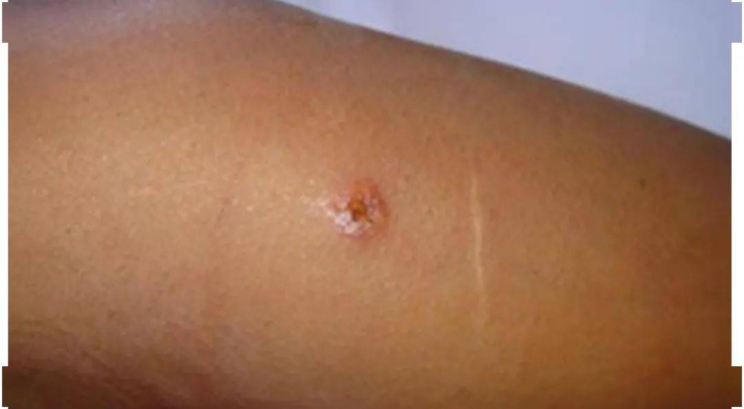 带您走近炭疽的世界