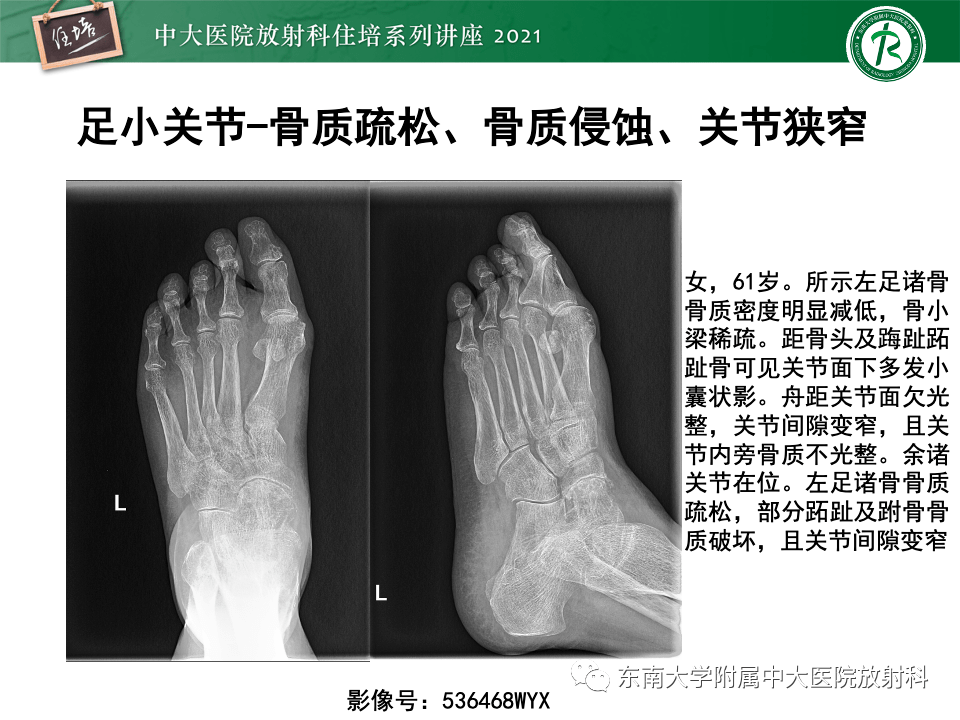 类风湿关节炎的影像学诊断