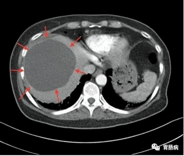 肝脏|体检发现“肝囊肿”怎么办？会不会变癌？要不要吃药？医生给你说清楚