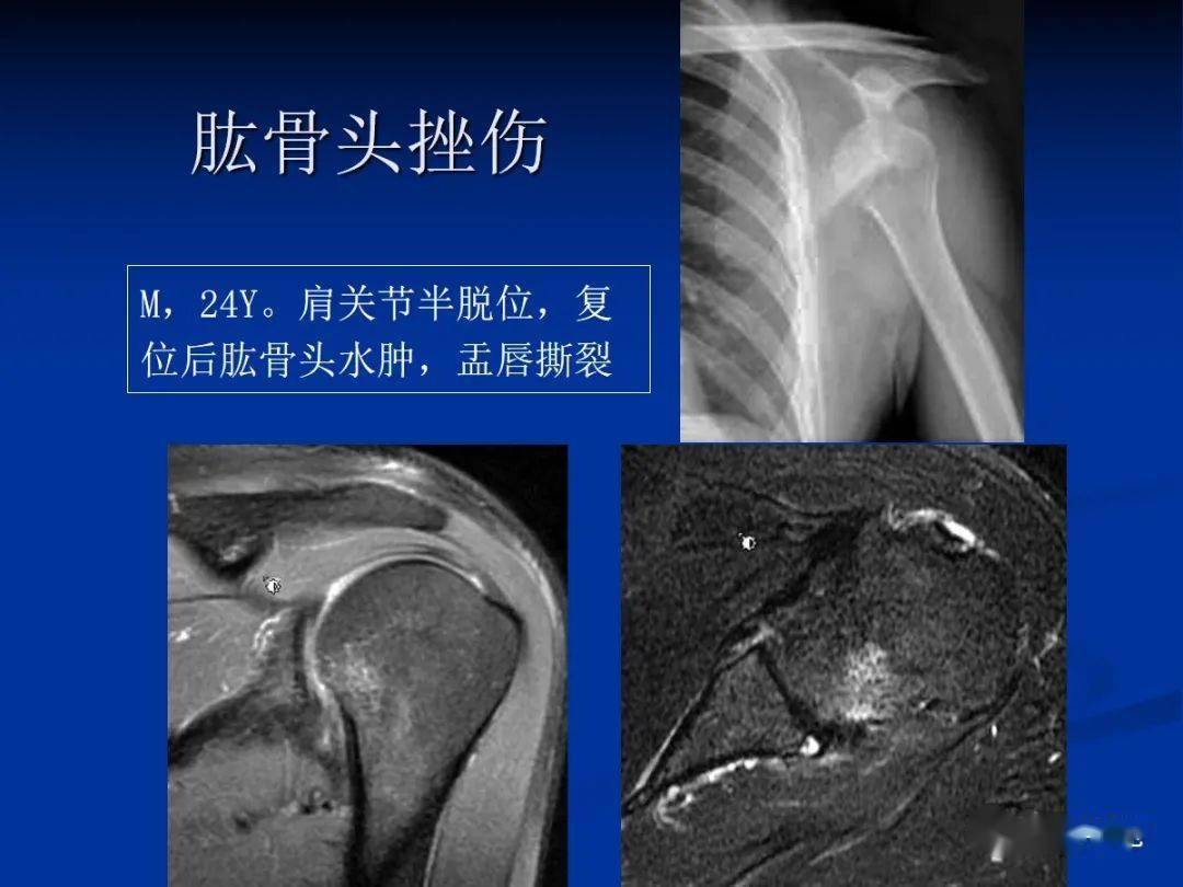 肩袖解剖及损伤的临床及mri诊断