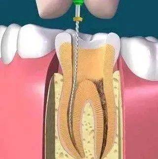 侧穿和断针的完全预防处理_治疗