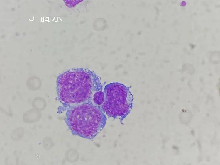 05形态特征:在嗜多色性或嗜碱性点彩红细胞胞质中出现的紫红色细线圈