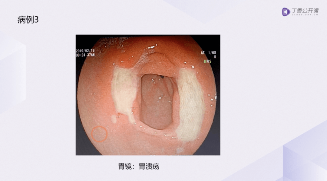 收藏手把手教你腹痛問診查體輔助檢查解讀