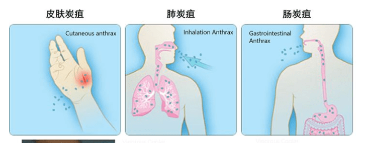 皮肤炭疽及时治疗病死率小于1%. 肺炭疽死亡率可达90%以上.