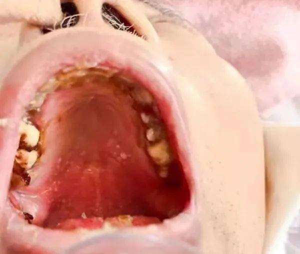 在水疱融合的同时,患者口腔上颚,下腹腹壁也出现众多米粒样小水疱