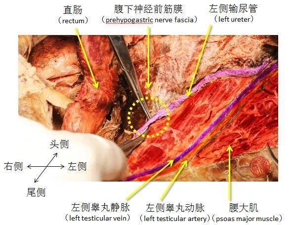 医学图说乙状结肠间隐窝的应用解剖学