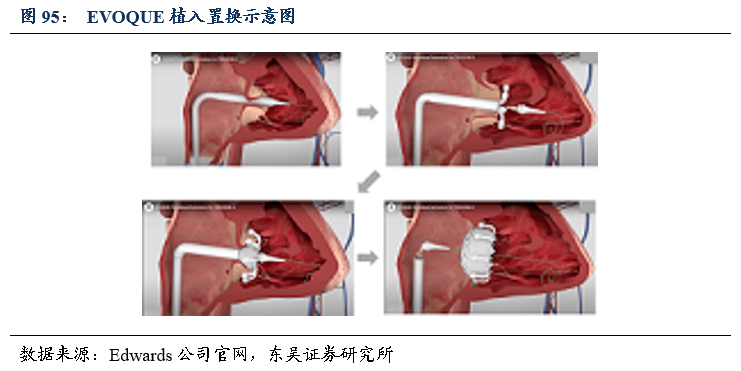 爱德华公司的evoque产品是由自膨式镍钛合金支架,牛心包瓣叶,编织物