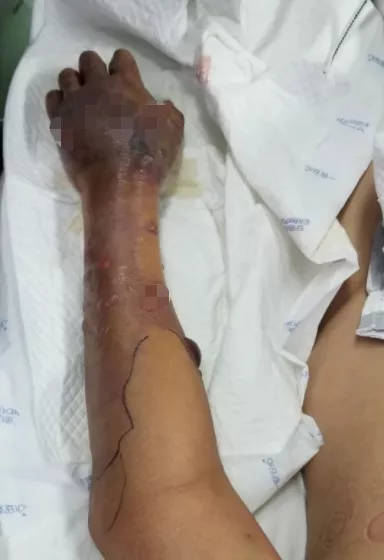 可怜!广西老伯被截肢还险丧命,只因处理海鲜时破了点皮