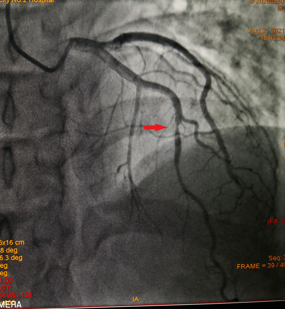 一科一品渭南市第二医院心血管内科之冠状动脉介入手术