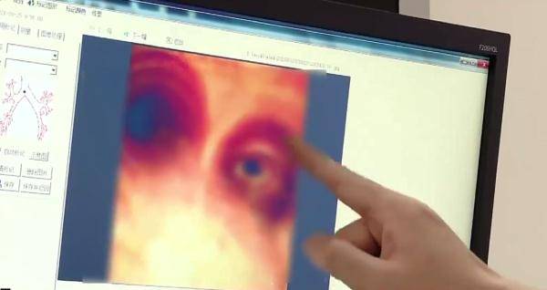 哨子|广东小伙被肺炎困扰20年，起因是6岁玩的一个玩具，家里有这个的注意了