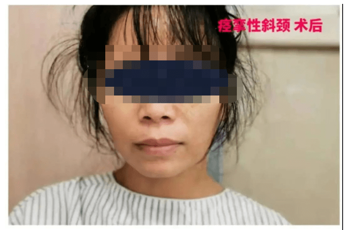 脖子|女子歪脖子六年，一直以为是落枕！病因竟是……