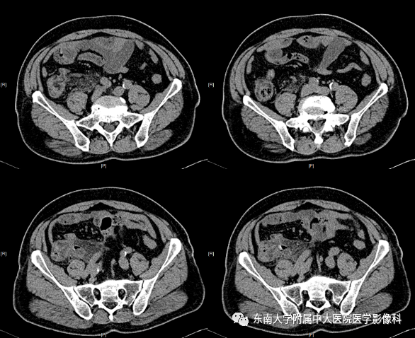 阑尾炎详细ct影像表现解读