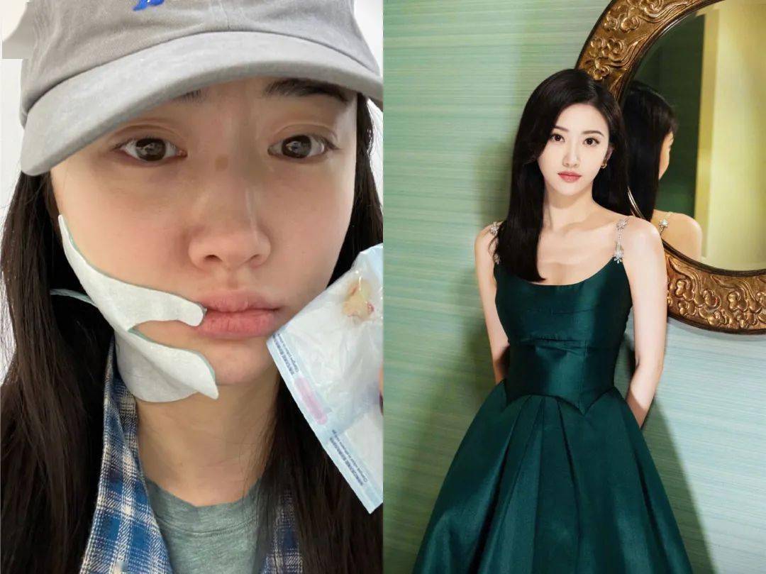 景甜素颜曝光认不出,自拍双眼皮疤痕明显,曾大方承认自己整容