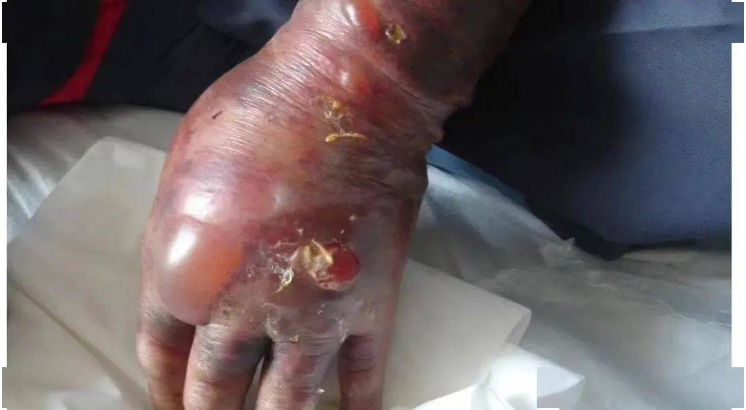 新型冠状病毒肺炎等艾滋病,病毒性肝炎炭疽和传染性非典型肺炎根据
