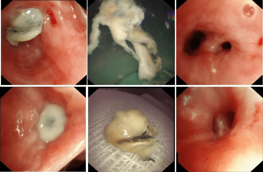 灌注|全身+局部 介入+灌注，清华长庚呼吸科治愈顽疾“肺毛霉菌病”