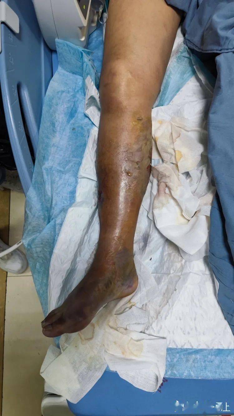 宁波阿姨海边玩一下午,第4天被截肢!医生:致死率很高,最近连遇3例