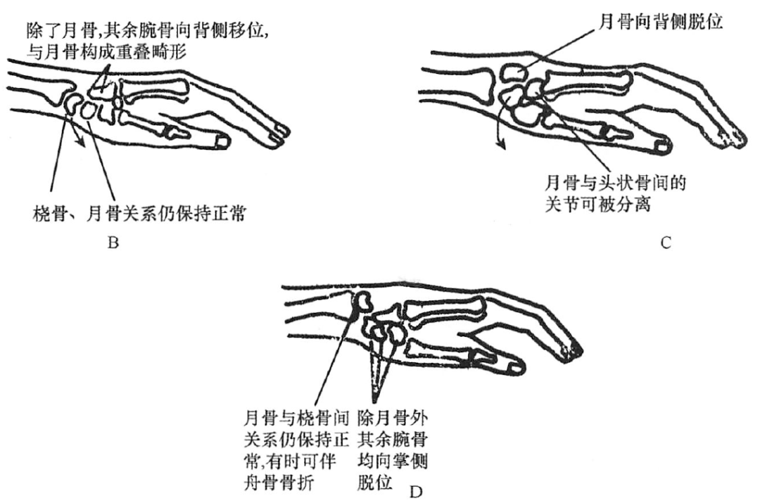 肱骨干骨折分型图片