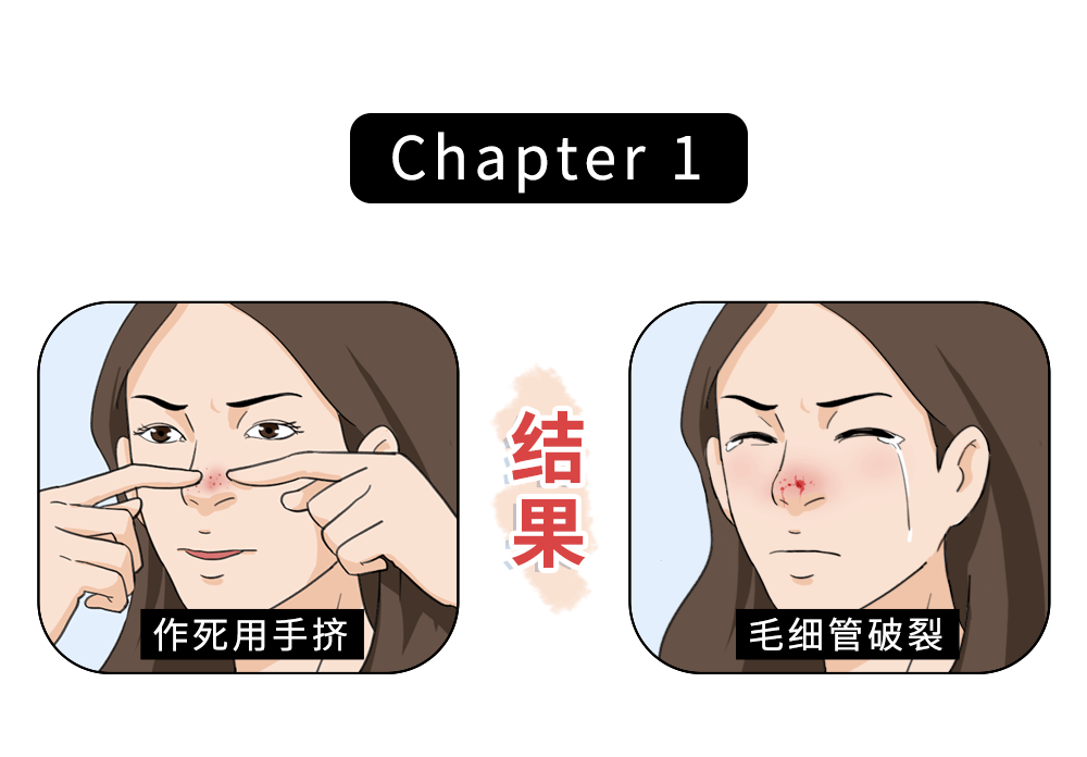 黑头1挤1个洞教你一招10年黑头不用挤鼻子滑溜到男朋友都想蹭