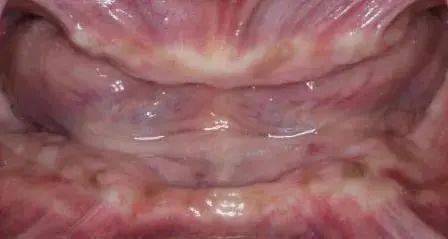 福利|种植牙大咖面对面+超强福利，机不可失，11—12日能省一大笔钱！！！