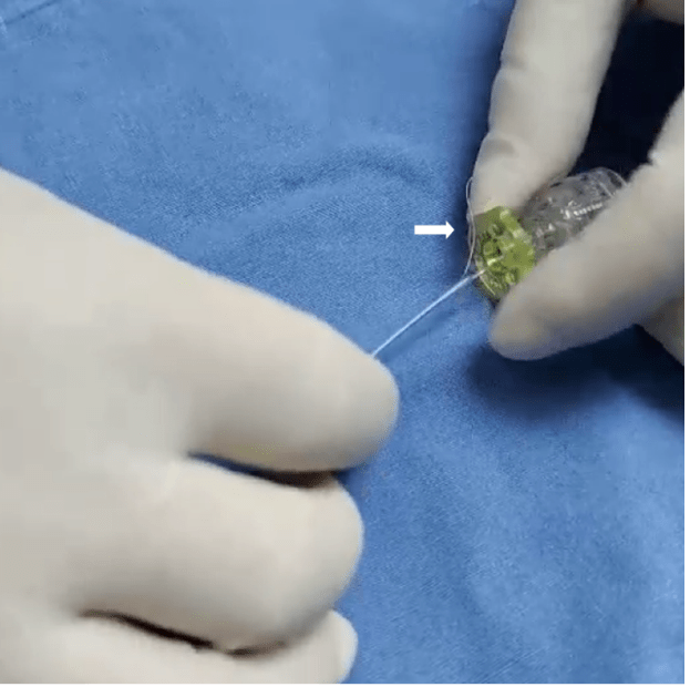 导丝塑好形后,送入双腔微导管.