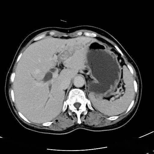 早期肝硬化伴肝内胆管结石