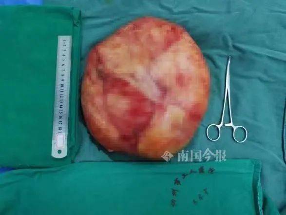 阿婆|柳州这81岁阿婆腹围不断增大，以为是“发福”！没想到 ...