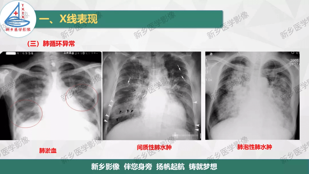 如何在胸片上觀察心臟及血管的變化