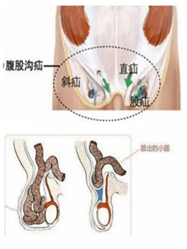 腹股沟疝气位置图片图片