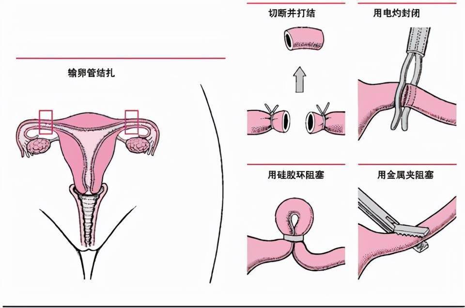 为什么结扎的基本都是男性其实女性也可以只是会面临5个弊端