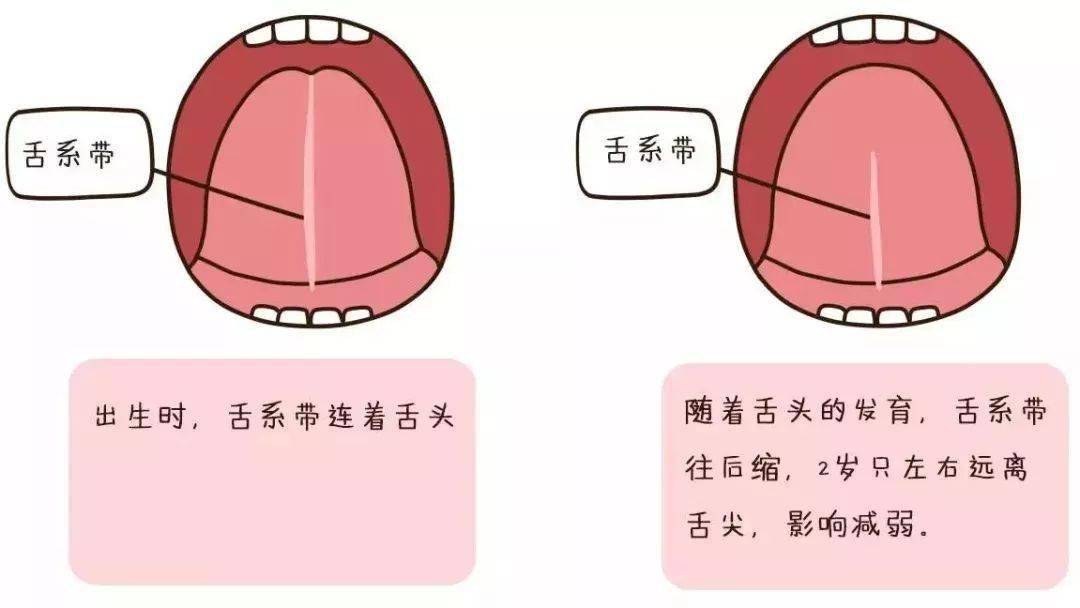 小知识:什么是舌系带短
