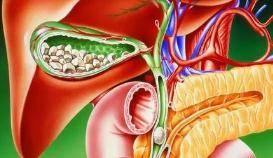 胆色素|为健康少吃肉，却招来胆结石？