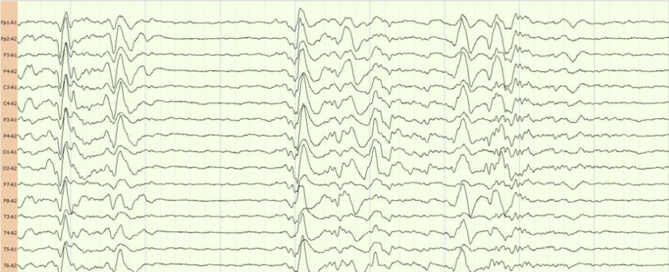 图1 心电图提示前壁st段抬高,下壁异常q波,t波改变生命如同风中残烛