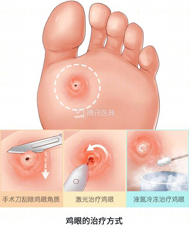 高跟鞋|“鸡眼”偏爱这4种人，你中招了吗？