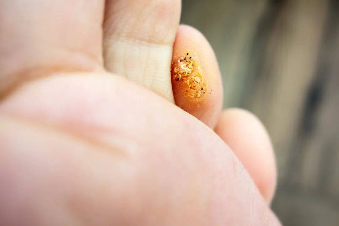 高跟鞋|“鸡眼”偏爱这4种人，你中招了吗？