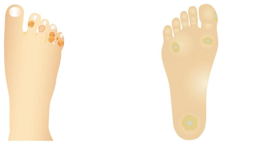 高跟鞋|“鸡眼”偏爱这4种人，你中招了吗？