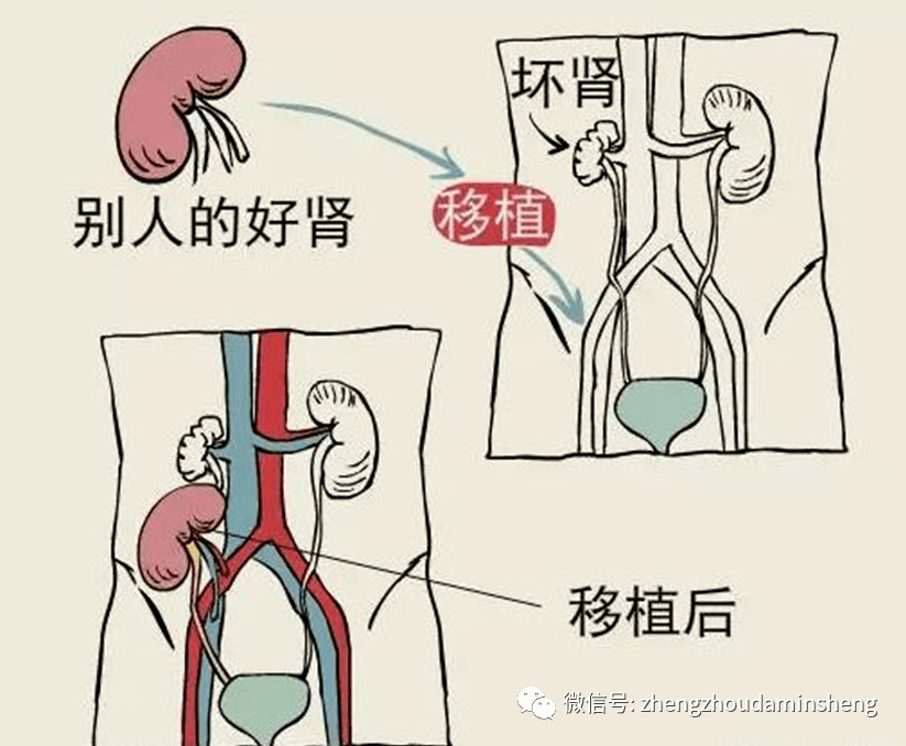 韩健乐:肾脏移植供体的来源有两条途径,一条途径是亲属之间的肾脏移植