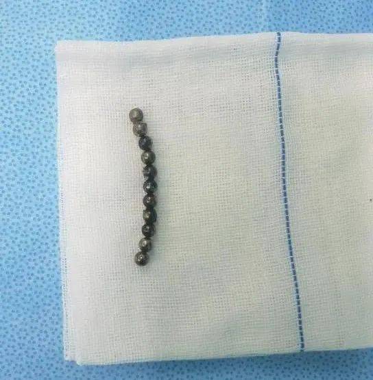 严重|家长注意！三岁男童误吞“夺命玩具”致严重肠穿孔